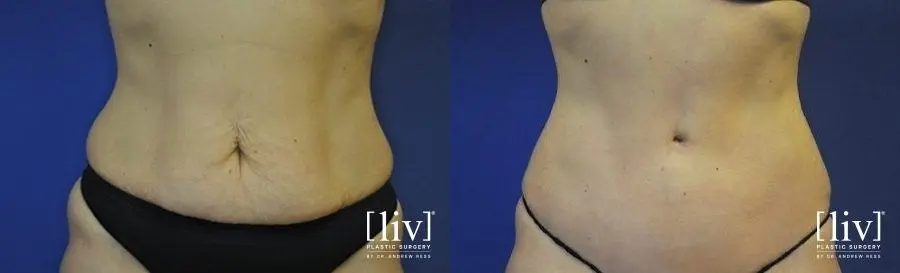 Abdominoplasty: Patient 13 - Before and After 1