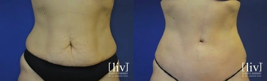 Abdominoplasty: Patient 9 - Before and After 1