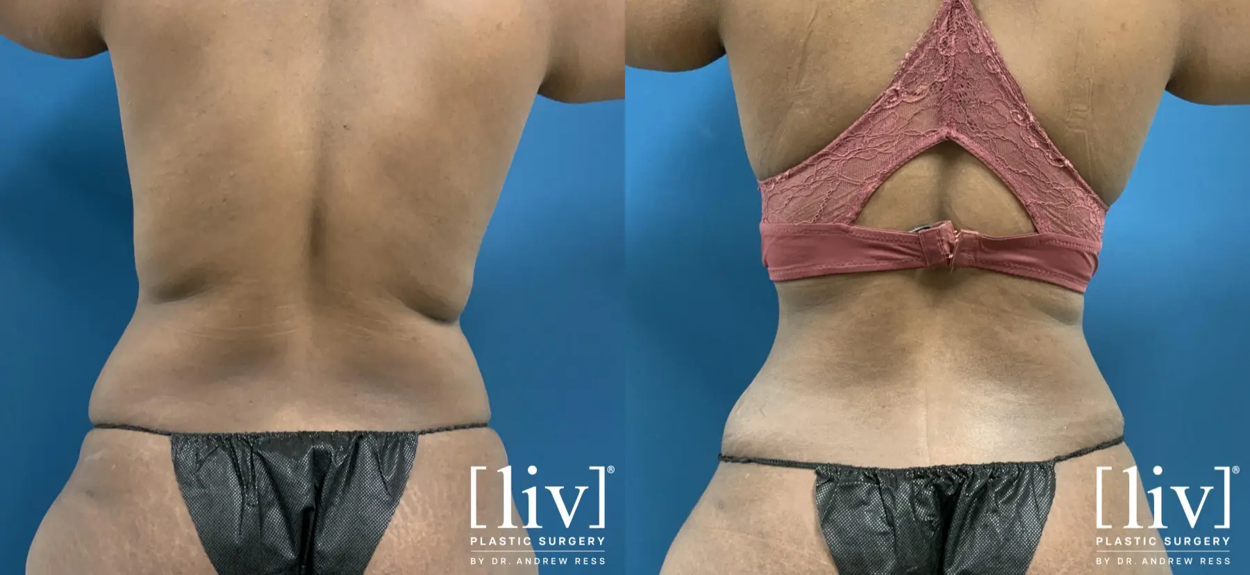 Abdominoplasty: Patient 11 - Before and After 6
