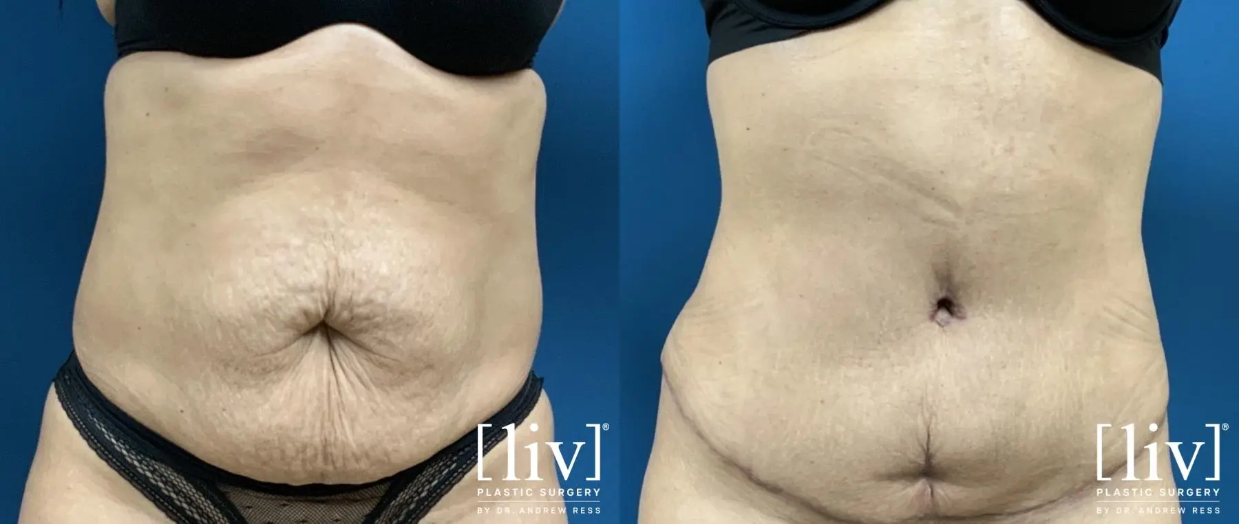Lipoabdominoplasty - Before and After 3