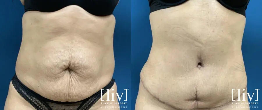 Abdominoplasty: Patient 3 - Before and After 3