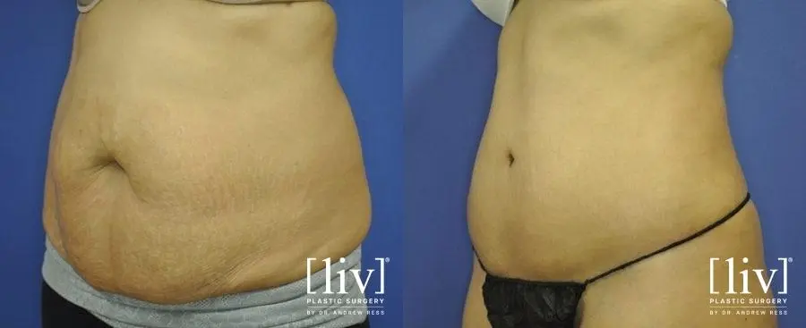 Abdominoplasty: Patient 7 - Before and After 4