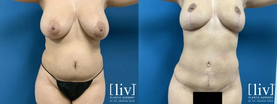 Lipoabdominoplasty - Before and After 1