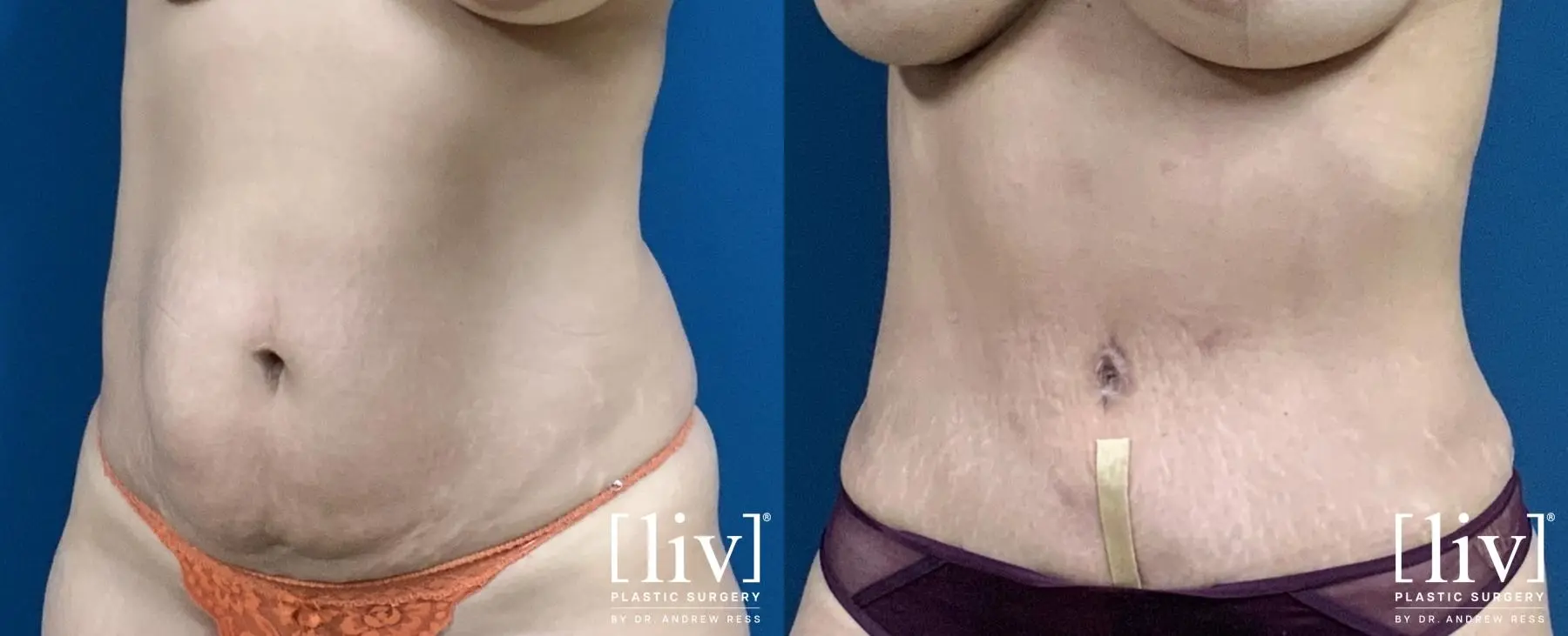 Lipoabdominoplasty - Before and After 2