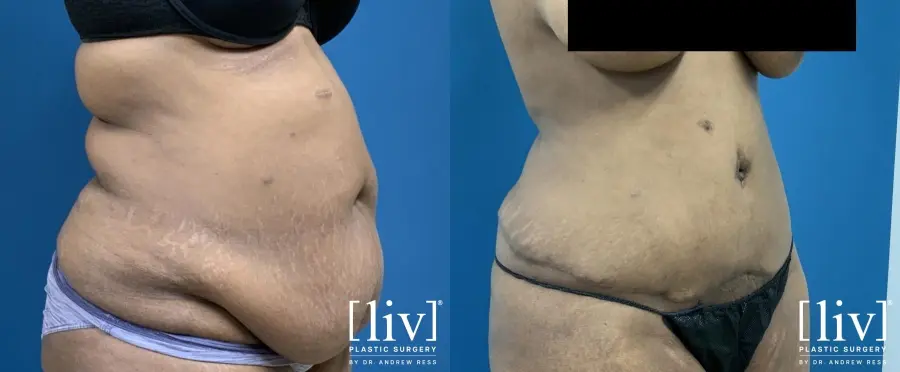 Abdominoplasty: Patient 1 - Before and After 2