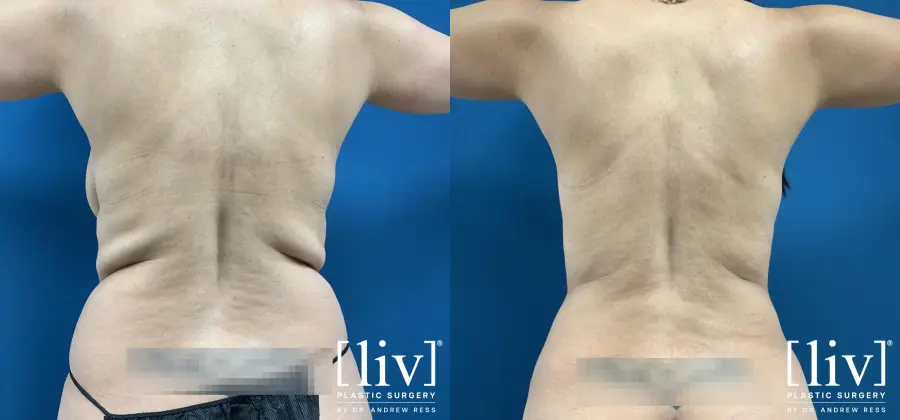 Lipoabdominoplasty - Before and After 6