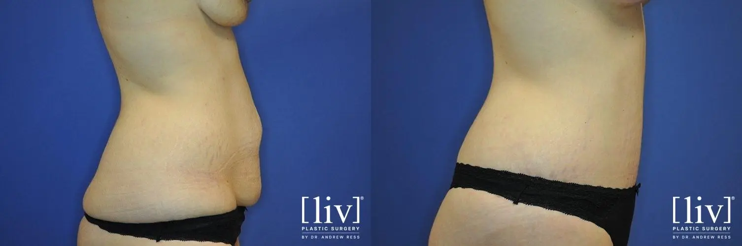 Abdominoplasty: Patient 15 - Before and After 3