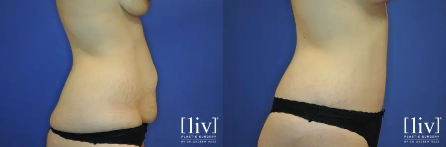 Abdominoplasty: Patient 11 - Before and After 3