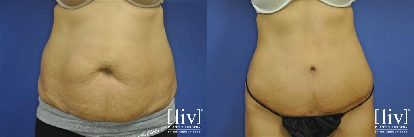 Abdominoplasty: Patient 10 - Before and After  