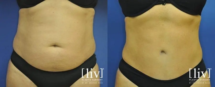Abdominoplasty: Patient 6 - Before and After 1