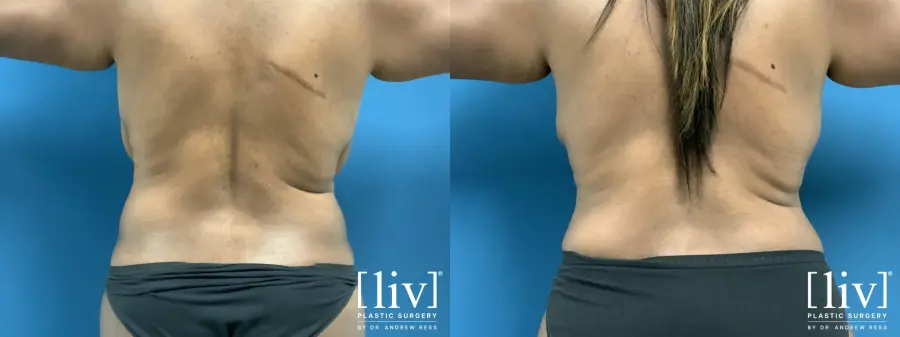 Lipoabdominoplasty - Before and After 6