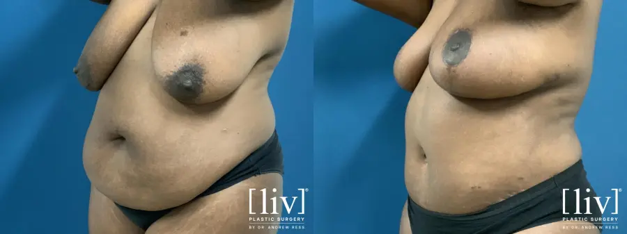 Lipoabdominoplasty - Before and After 2