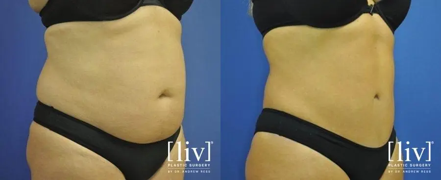 Abdominoplasty: Patient 6 - Before and After 2