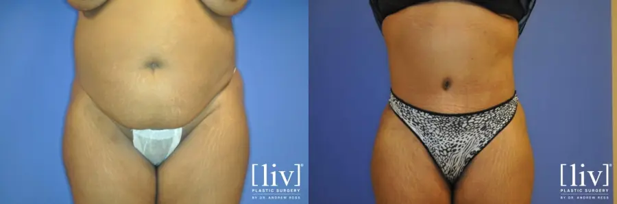 Abdominoplasty: Patient 5 - Before and After 1