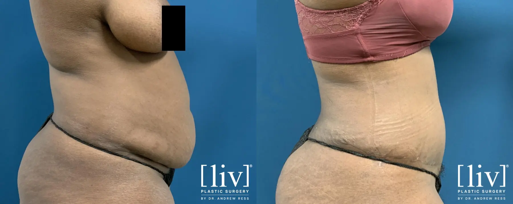 Abdominoplasty: Patient 11 - Before and After 5