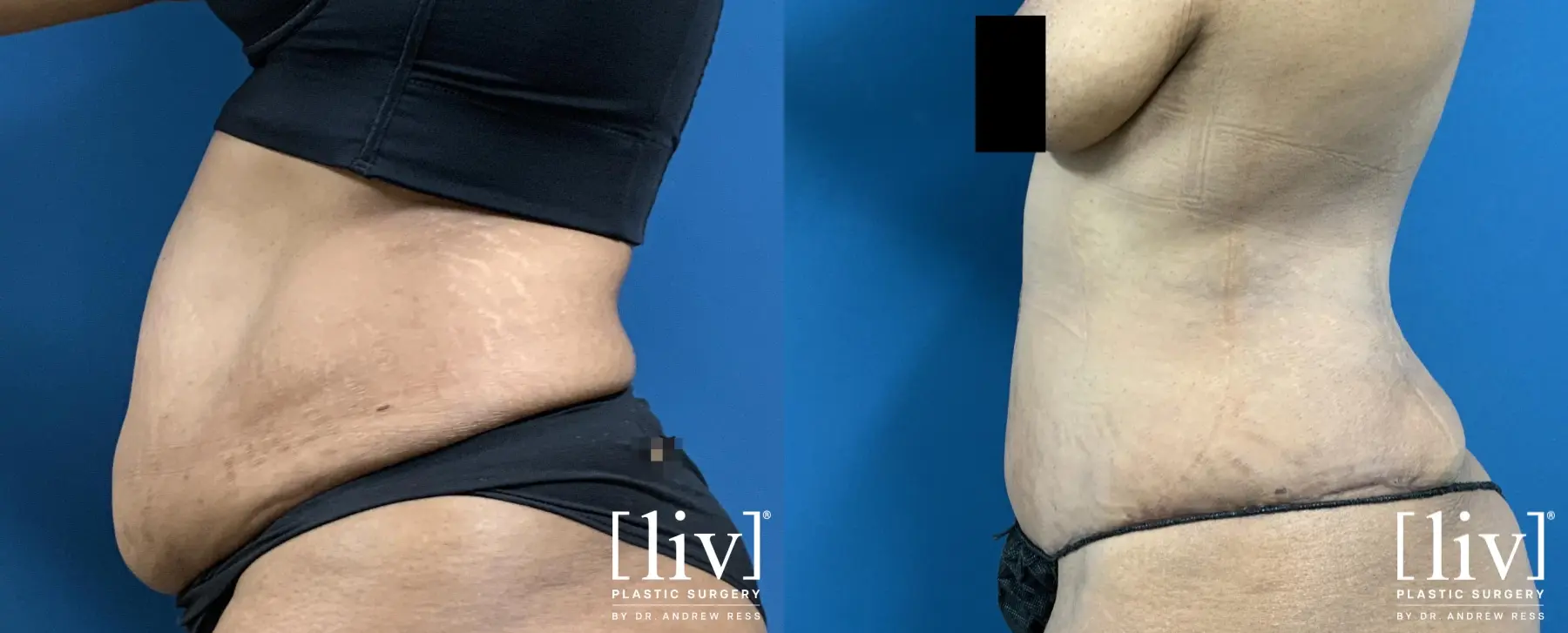 Lipoabdominoplasty - Before and After 3