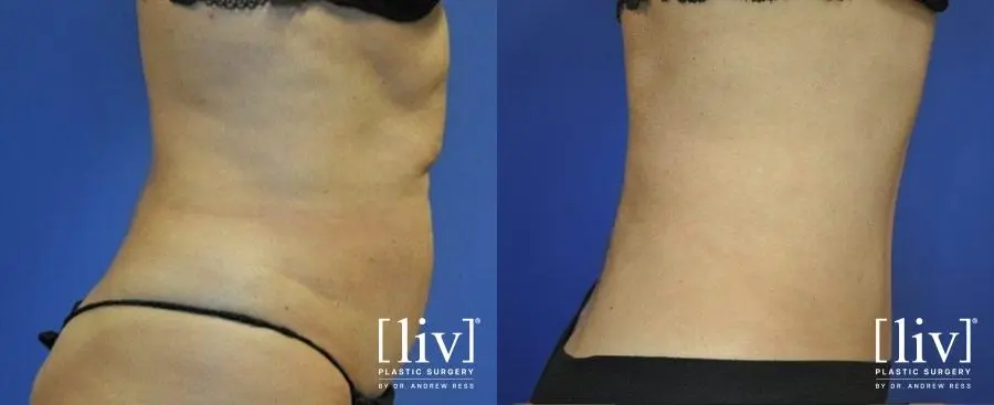 Abdominoplasty: Patient 8 - Before and After 3