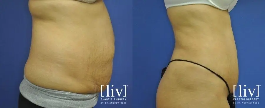 Abdominoplasty: Patient 10 - Before and After 3