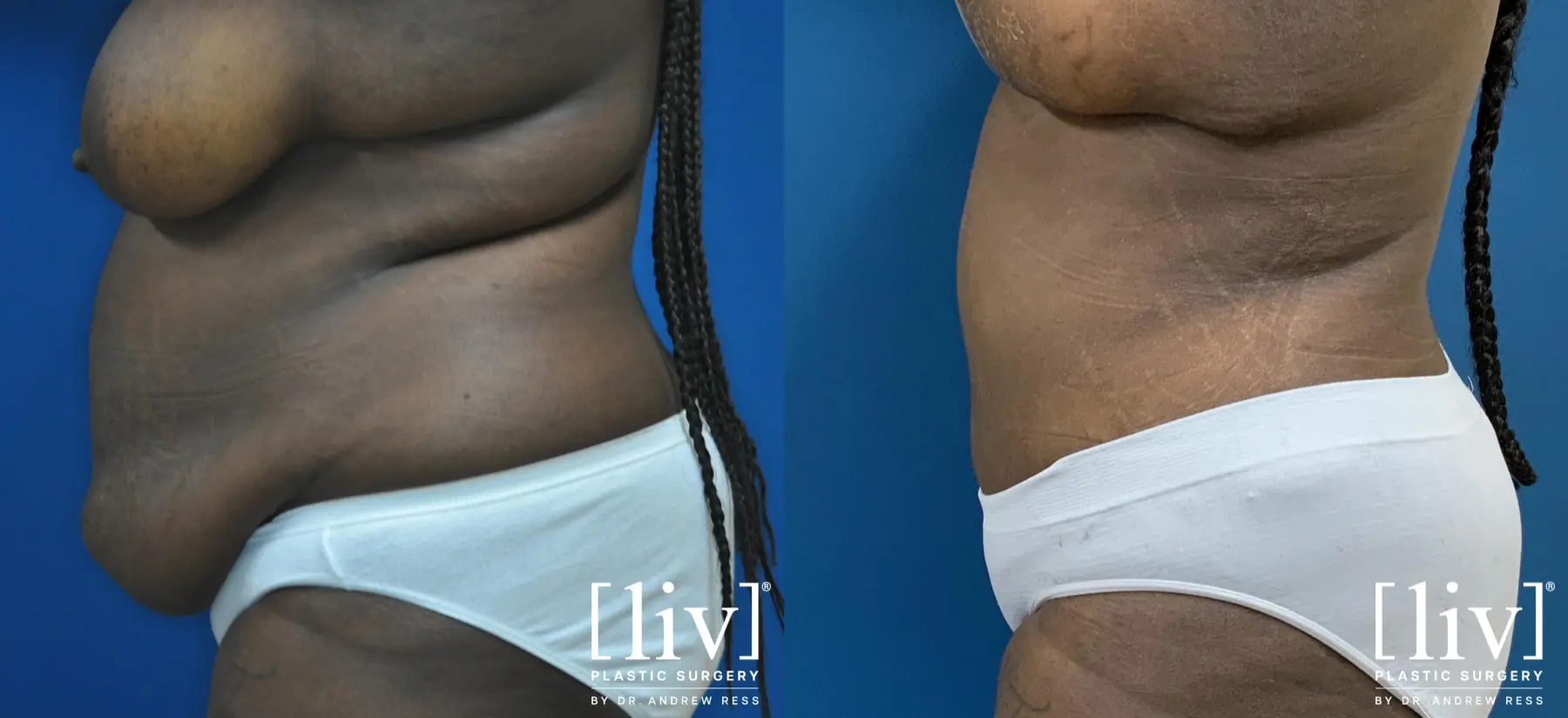 Lipoabdominoplasty - Before and After 3