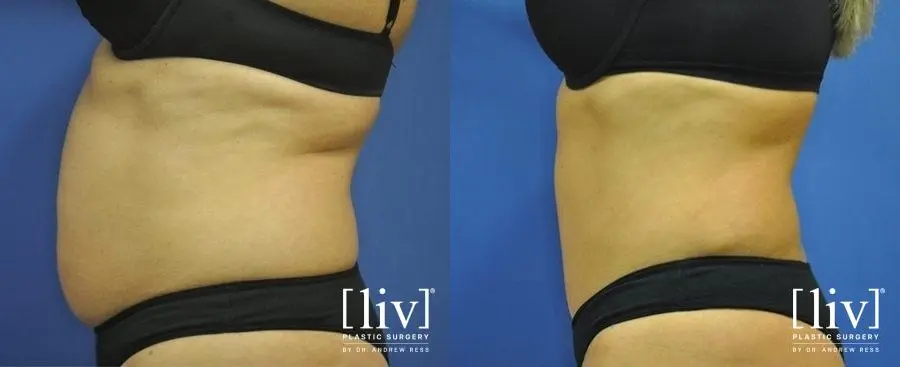 Abdominoplasty: Patient 9 - Before and After 5