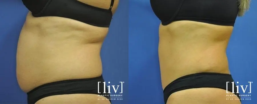 Abdominoplasty: Patient 6 - Before and After 5
