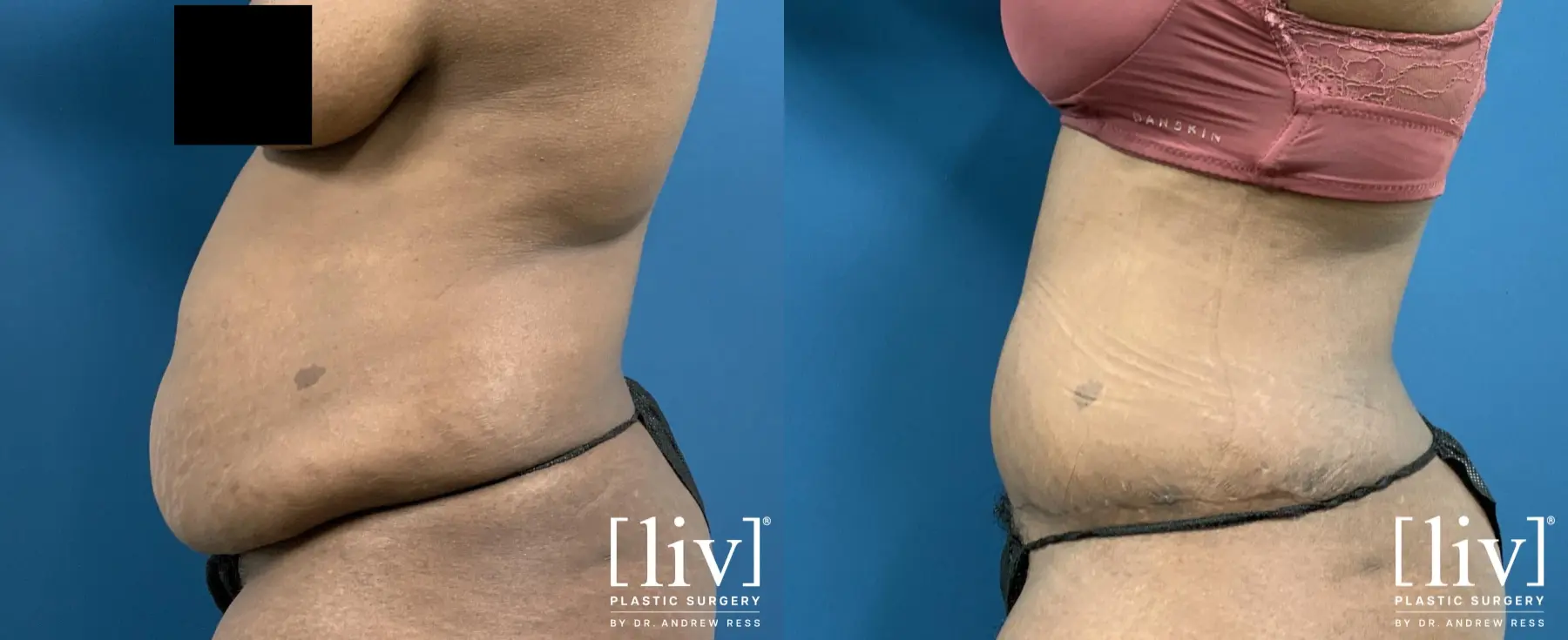 Abdominoplasty: Patient 11 - Before and After 3