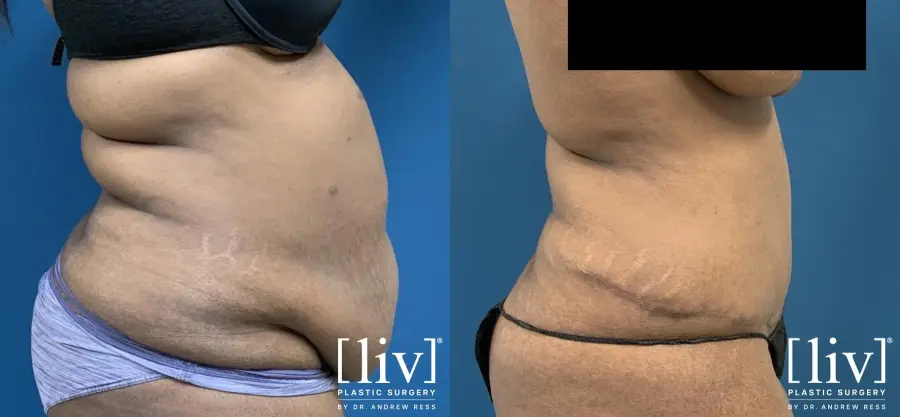 Abdominoplasty: Patient 1 - Before and After 3