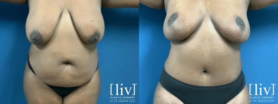Lipoabdominoplasty - Before and After 1