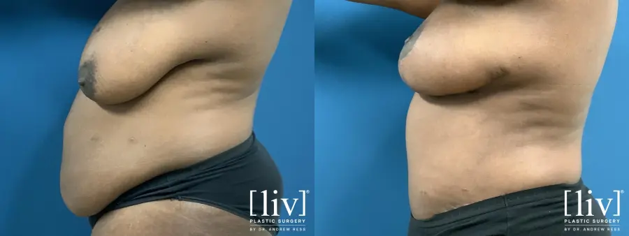 Lipoabdominoplasty - Before and After 3