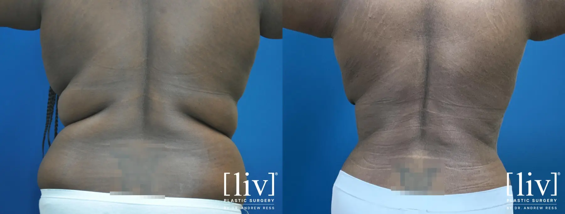 Lipoabdominoplasty - Before and After 4