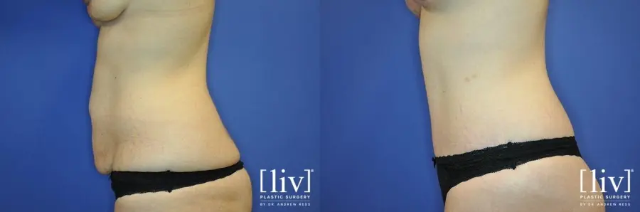 Abdominoplasty: Patient 11 - Before and After 5
