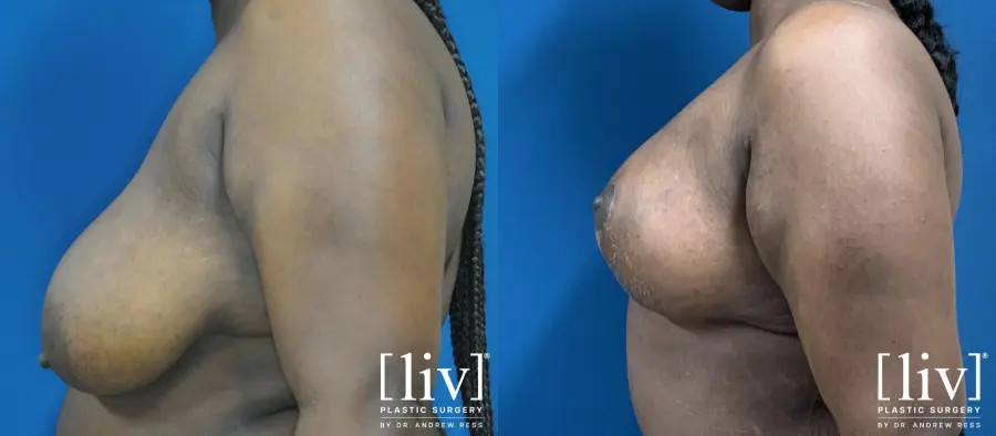 Lipoabdominoplasty - Before and After 7