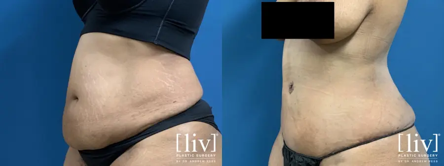 Lipoabdominoplasty - Before and After 2