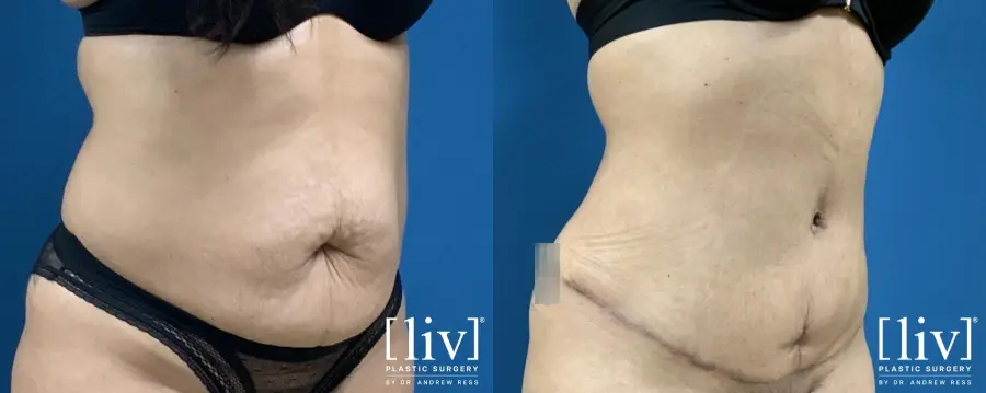 Abdominoplasty: Patient 3 - Before and After 2