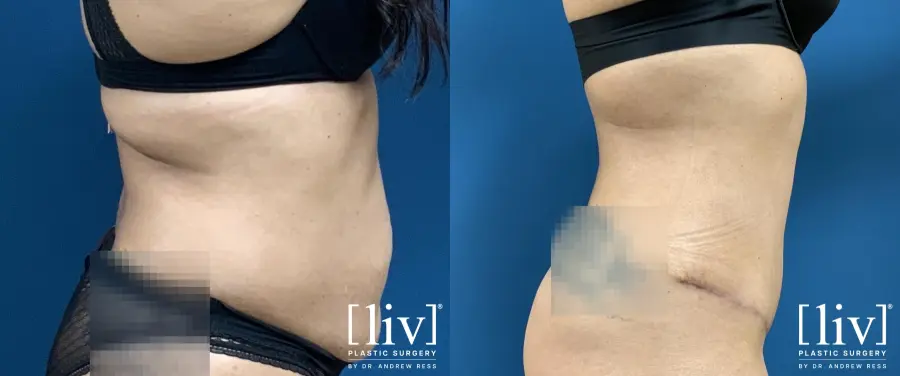 Abdominoplasty: Patient 3 - Before and After 1