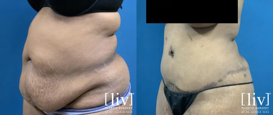 Abdominoplasty: Patient 1 - Before and After 4