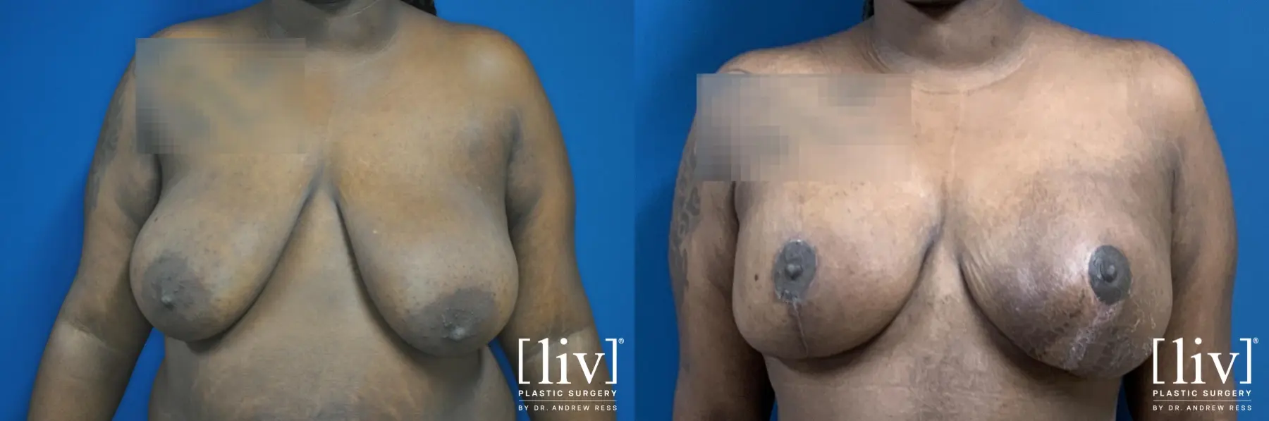 Lipoabdominoplasty - Before and After 5