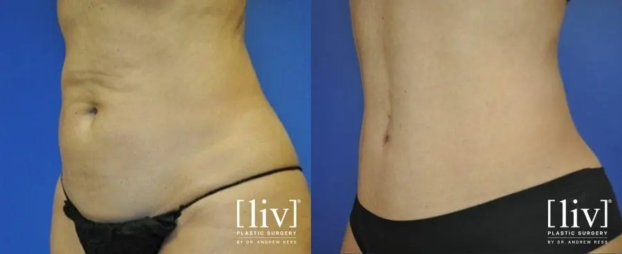 Abdominoplasty: Patient 12 - Before and After 4