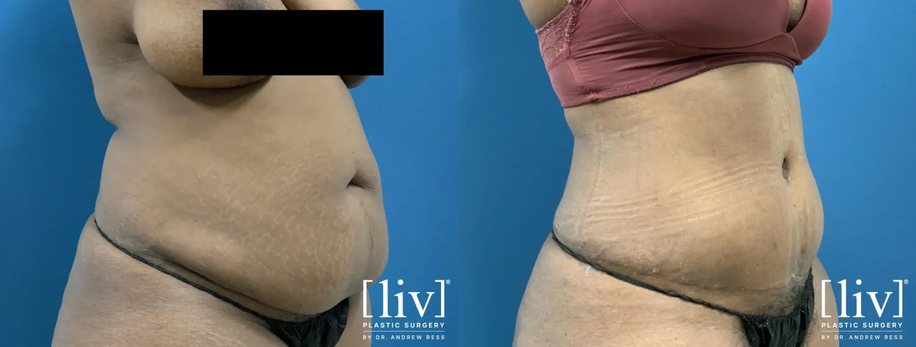 Abdominoplasty: Patient 11 - Before and After 4