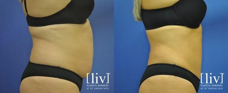 Abdominoplasty: Patient 6 - Before and After 3