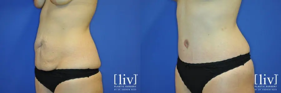 Abdominoplasty: Patient 11 - Before and After 4