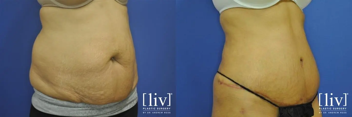 Abdominoplasty: Patient 10 - Before and After 2