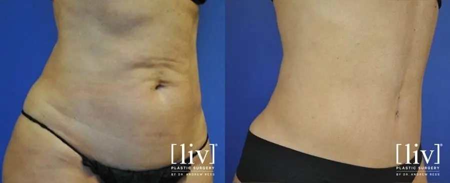 Abdominoplasty: Patient 12 - Before and After 2