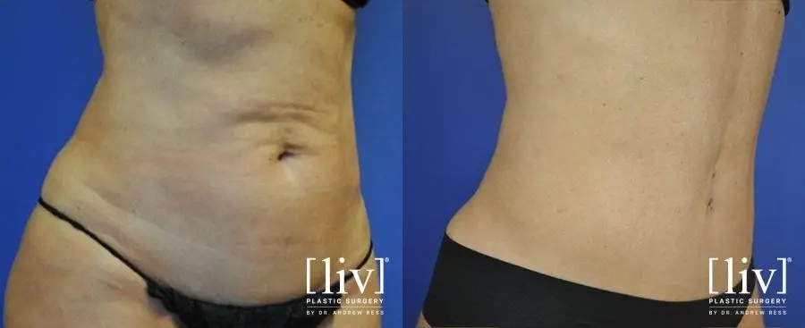 Abdominoplasty: Patient 8 - Before and After 2