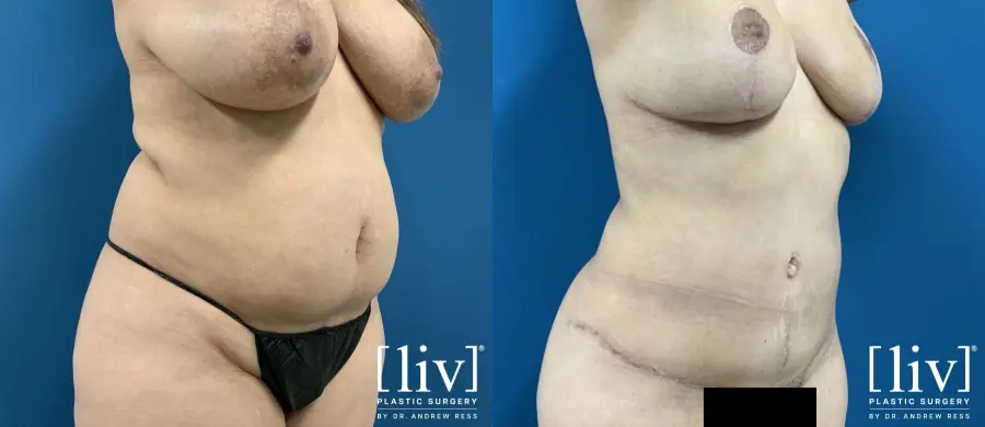 Lipoabdominoplasty - Before and After 4