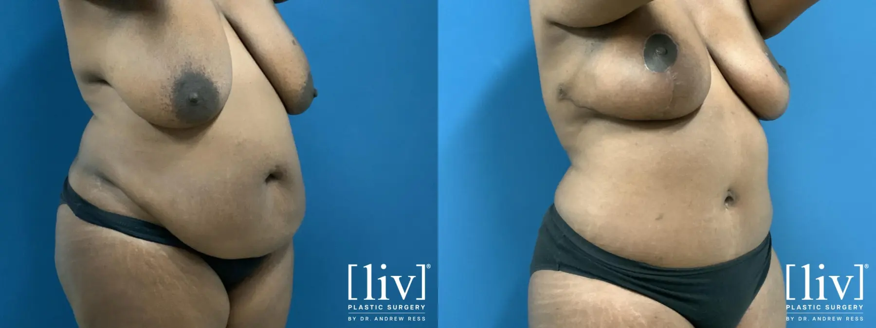 Lipoabdominoplasty - Before and After 4