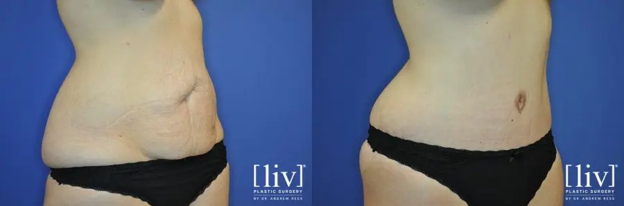 Abdominoplasty: Patient 11 - Before and After 2