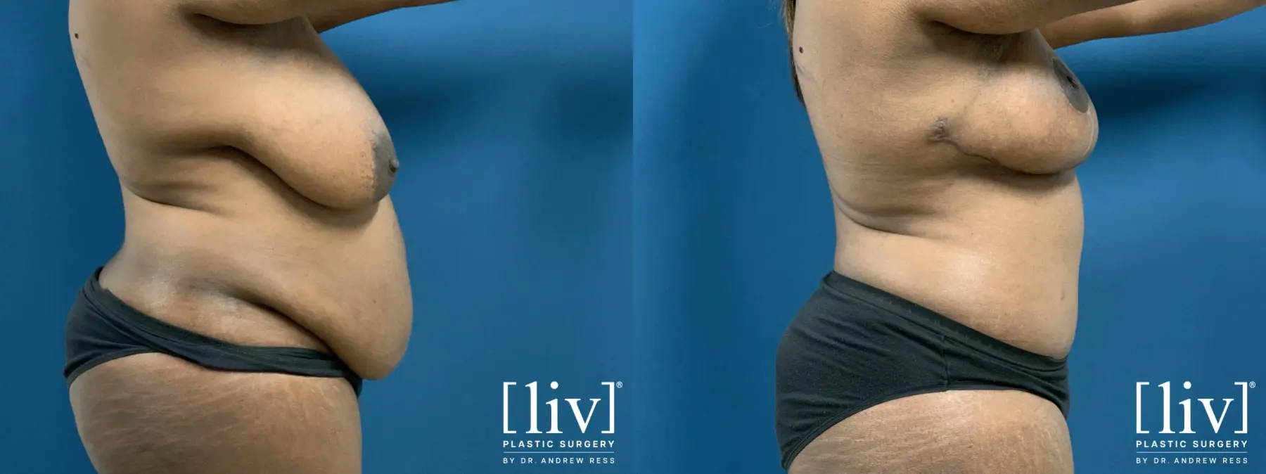Lipoabdominoplasty - Before and After 5