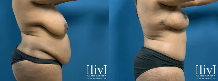 Lipoabdominoplasty - Before and After 5