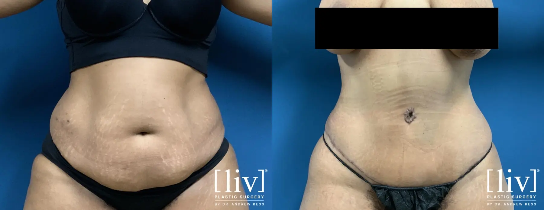 Lipoabdominoplasty - Before and After  